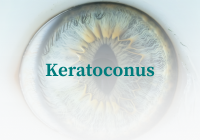 kerataconus